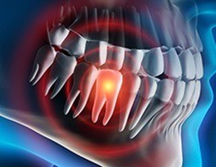 Animation of damaged tooth