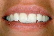 Whitened front tooth