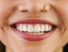 Woman smiling with Invisalign inserted