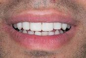 Closed gap between front teeth