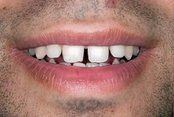 Gap between front teeth