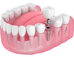 Illustration of a single dental implant