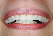 Whitened teeth