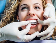 Dentist removing a patient’s Invisalign aligners