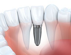 Animation of implant supported dental crown