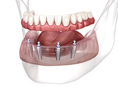 Illustration showing four dental implants in lower jaw anchoring full set of dentures