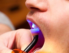 dentist bonding a patient’s tooth