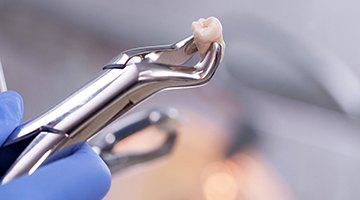 dentist performing a tooth extraction in Newark holding dental forceps