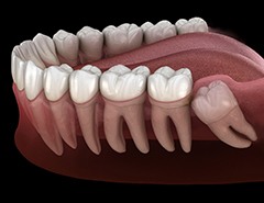 computer illustration of impacted wisdom teeth growing beneath the gums