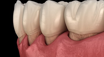 computer model of receding gums