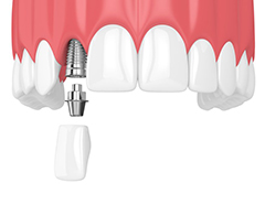 single dental implant with a crown 
