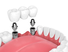 two dental implants holding a dental bridge 