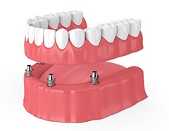 four dental implants holding a full denture 