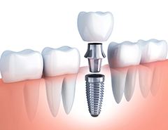 dental implant with abutment and crown being placed in the jaw 