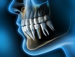 X-ray of a patient with a dental implant