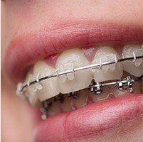 Close up of a person's teeth with braces