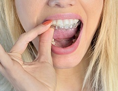 young woman placing Invisalign in Newark in her mouth 