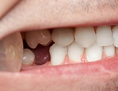 Closeup of smile with missing tooth