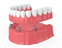 model of implant-retained dentures