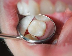 Closeup of smile after dental treatment