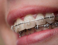 Closeup of teeth with braces