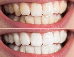 Closeup of teeth before and after whitening