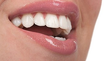 Close up of woman’s teeth with veneers