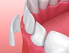 Animation of porcelain veneer placement