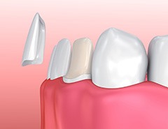 Model of a tooth prepared for a veneer