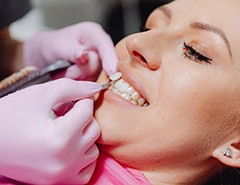Dentist applying a veneer to a woman’s tooth