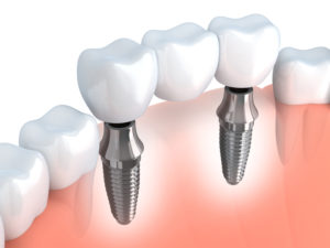 You don’t have to endure smile gaps. Replace teeth with superior prosthetic options from your dentists in Newark, Drs. Bond and Garfield.