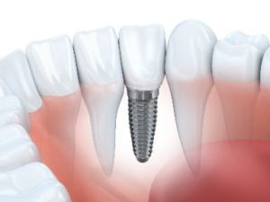 Dental implant in lower jaw