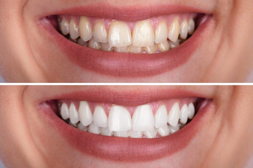 Two photos of before and after teeth whitening