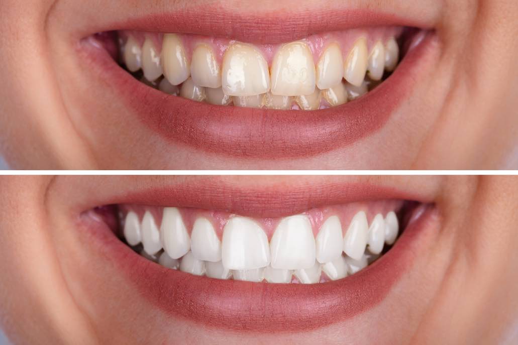 How to Keep Your Teeth White After Cosmetic Dentistry