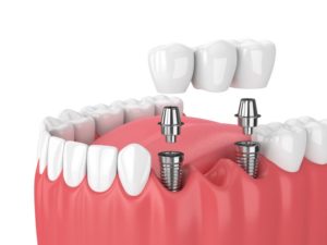 dental bridge supported by two dental implants in Newark