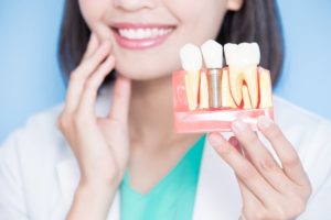 a woman holding a dental implant example