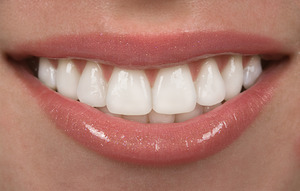 Close-up of teeth after a smile makeover