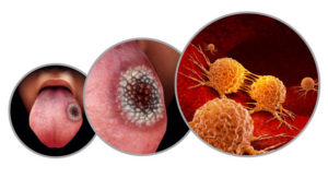 Examples of oral cancer