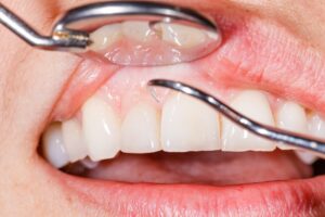 Close up of dental cleaning