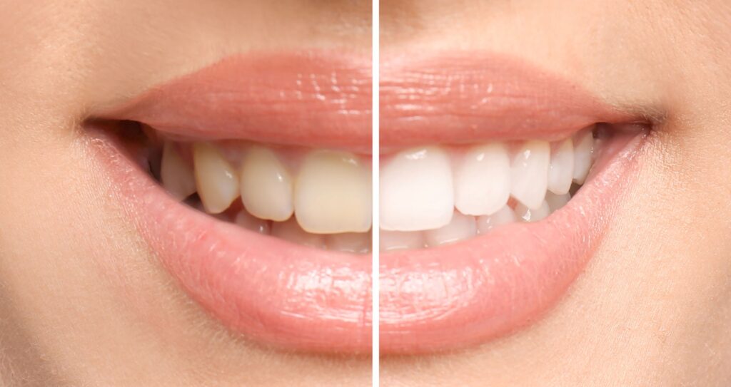 Closeup of woman's smile that's half whitened