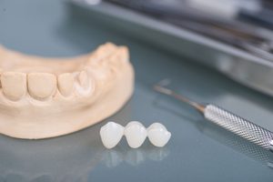 Dental bridge next to model teeth and dental instrument on reflective surface
